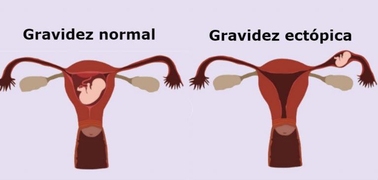 Gravidez Ectópica - Entenda como acontece - Portal Educação
