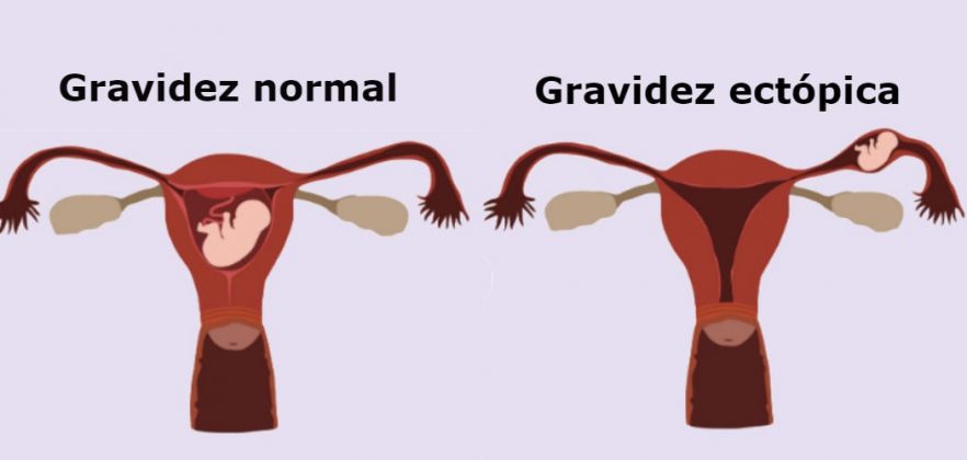 Gravidez Ectópica Entenda Como Acontece Portal Educação 